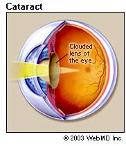 eye disease