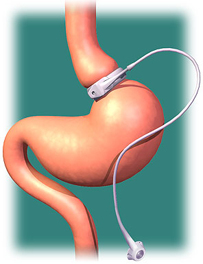 gastric band