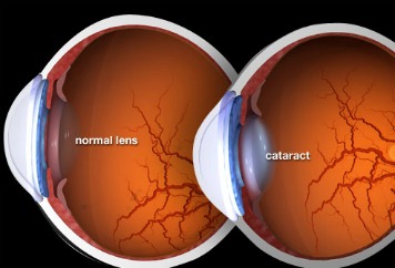 eye disease